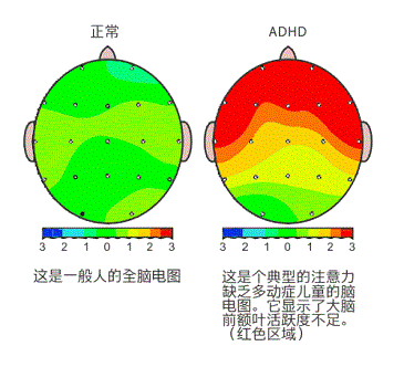 怎么判断孩子是不是多动症？