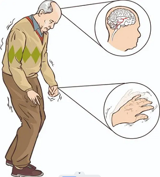 帕金森患者会有哪些症状？